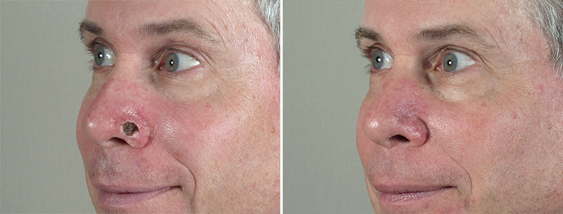 Skin Cancer Treatment Patient 32