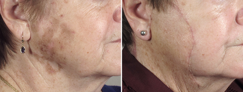 Skin Cancer Treatment Patient 33