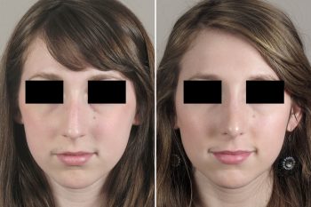 Rhinoplasty Patient 33