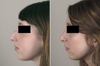 Rhinoplasty Patient 33