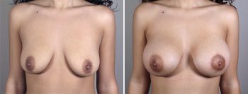 Breast Enlargement (Augmentation) Patient 55