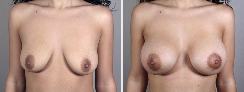 Breast Enlargement (Augmentation) Patient 55