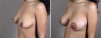 Breast Enlargement (Augmentation) Patient 55