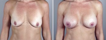 Breast Enlargement (Augmentation) Patient 54