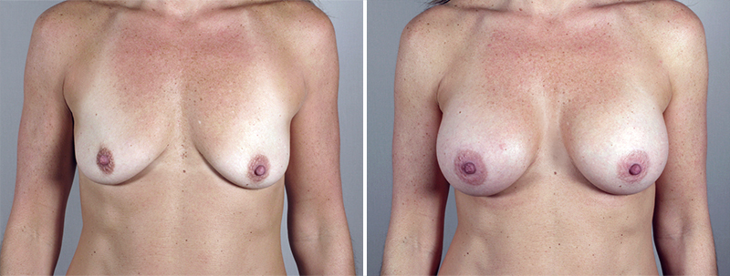 Breast Enlargement (Augmentation) Patient 54