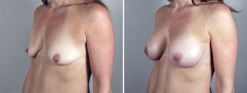 Breast Enlargement (Augmentation) Patient 54