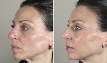 Skin Resurfacing Patient 1