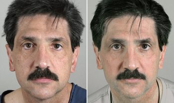 Skin Resurfacing Patient 3