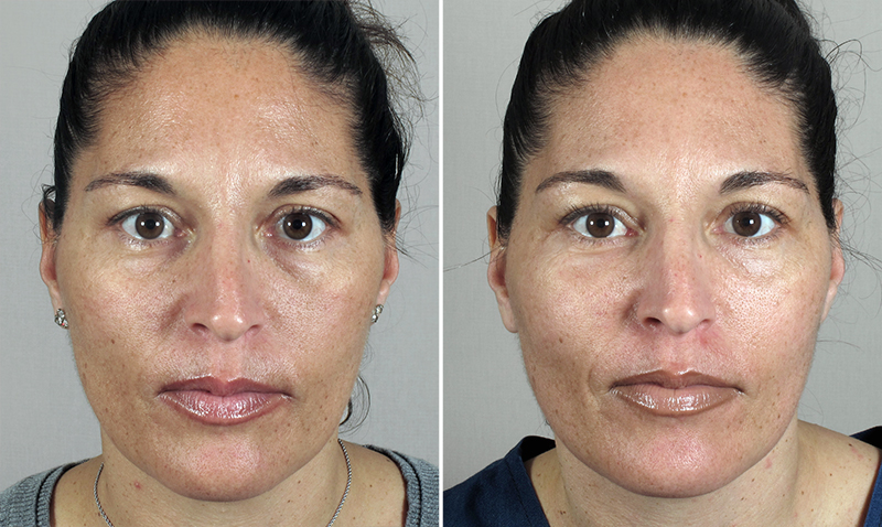 Skin Resurfacing Patient 4 – TCA Chemical Peel
