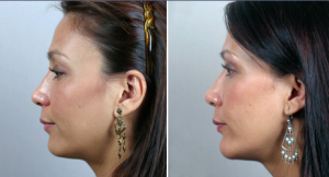 Chin Augmentation New Jersey