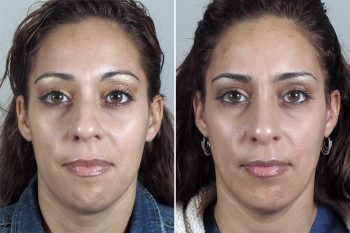 Rhinoplasty & Chin Implant Patient 34