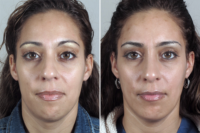 Rhinoplasty & Chin Implant Patient 34