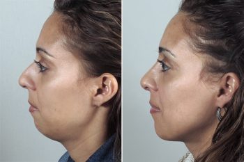 Rhinoplasty & Chin Implant Patient 34