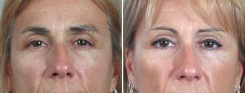 Upper Eyelid Lift Patient 3