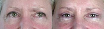 Upper Eyelid Lift Patient 8