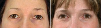 Upper Eyelid Lift Patient 1