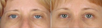 Upper Eyelid Lift Patient 2