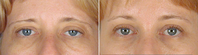 Upper Eyelid Lift Patient 2