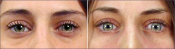 Lower Eyelid Lift Patient 1