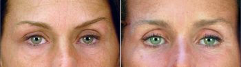 Upper & Lower Eyelid Lift Patient 1