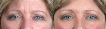 Lower Eyelid Lift Patient 2