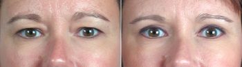 Upper Eyelid Lift Patient 4