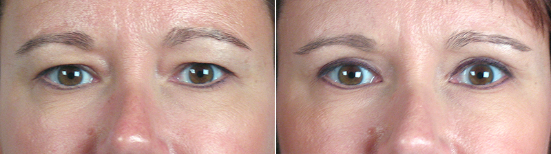 Upper Eyelid Lift Patient 4