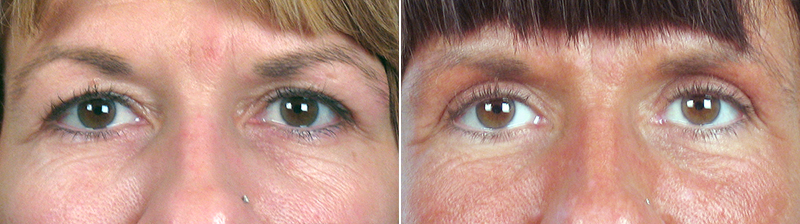 Upper Eyelid Lift Patient 5