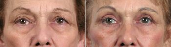Upper Eyelid Lift Patient 6
