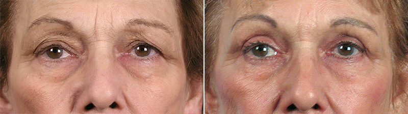 Upper Eyelid Lift Patient 6