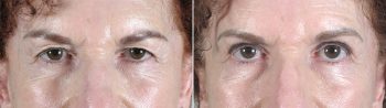 Upper Eyelid Lift Patient 7
