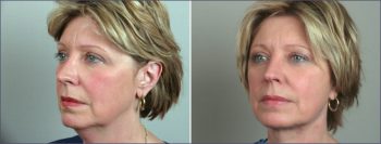 Lower Eyelid Lift Patient 2