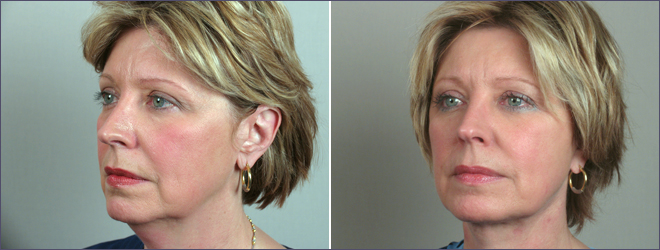 Lower Eyelid Lift Patient 2