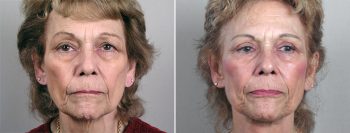 Upper Eyelid Lift Patient 6