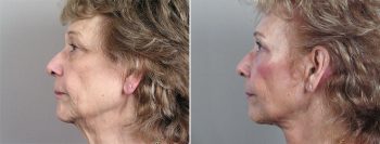 Upper Eyelid Lift Patient 6