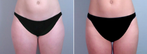 Liposuction