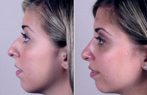 Rhinoplasty New Jersey