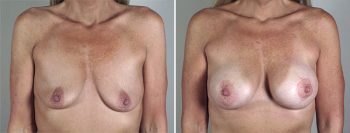 Breast Lift with Implants Patient 31