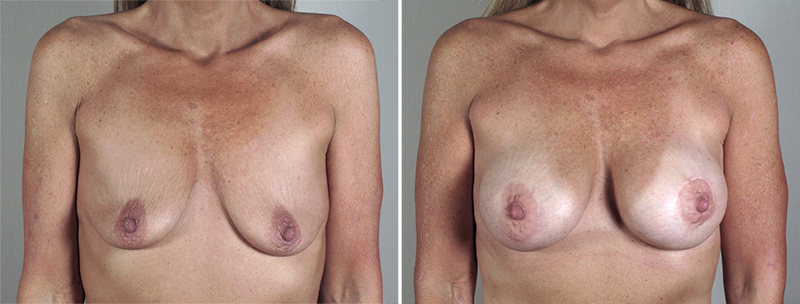 Breast Lift with Implants Patient 31