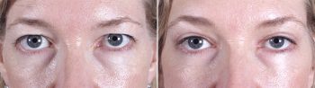 Upper & Lower Eyelid Lift Patient 11