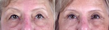 Upper & Lower Eyelid Lift Patient 8