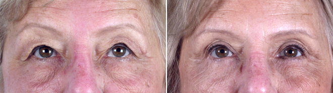 Upper & Lower Eyelid Lift Patient 8