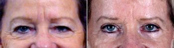 Upper & Lower Eyelid Lift Patient 9
