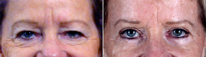 Upper & Lower Eyelid Lift Patient 9