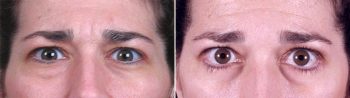 Lower Eyelid Lift Patient 4