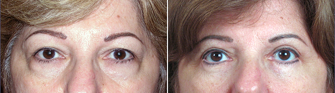 Upper & Lower Eyelid Lift Patient 2