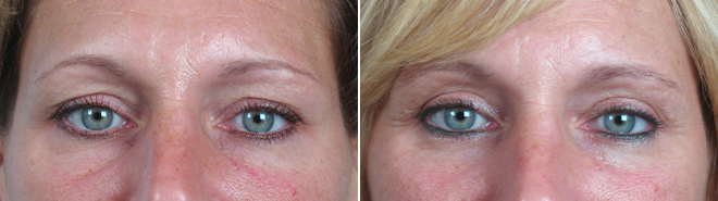 Upper & Lower Eyelid Lift Patient 4