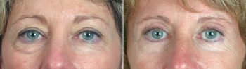 Upper & Lower Eyelid Lift Patient 5