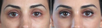 Upper & Lower Eyelid Lift Patient 7