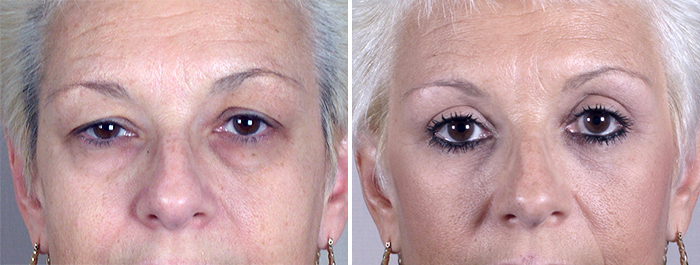 New Jersey Eyelid Surgery New Jersey Eyelid Surgery